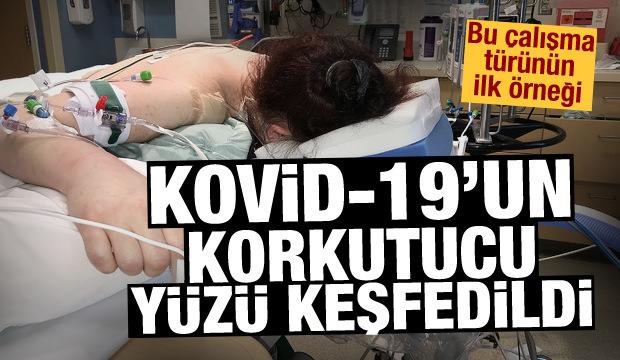Bu çalışma türünün ilk örneği! Bilim dünyası Kovid-19'un korkutucu yüzünü keşfetti