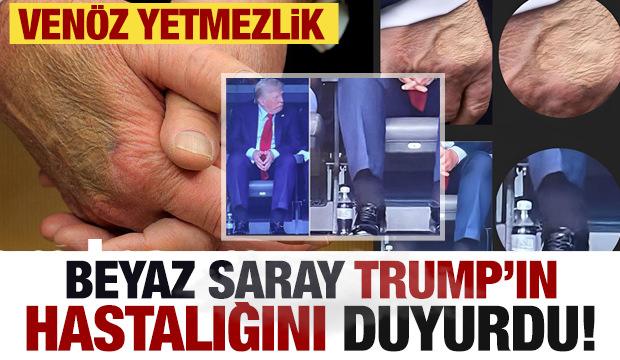 Beyaz Saray Trump'ın hastalığını açıkladı: Venöz yetmezlik