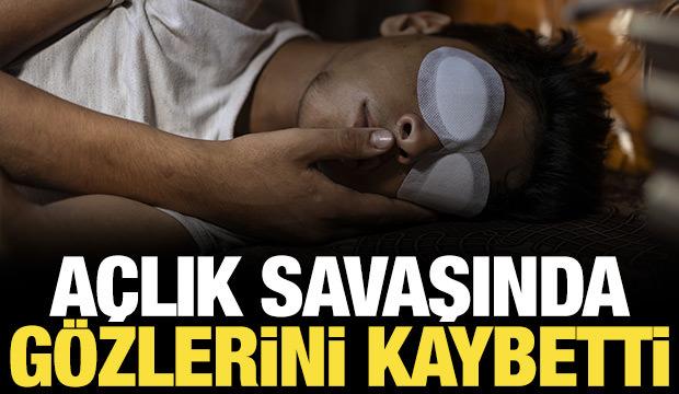 Açlık savaşında gözlerini kaybetti