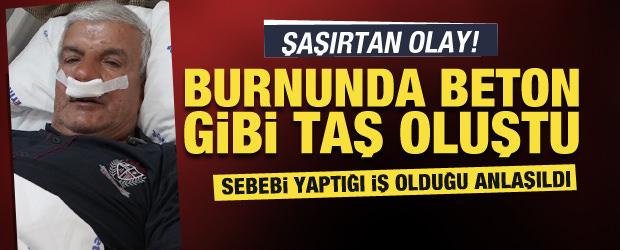 27 yıllık mesleğin şaşırtan sonucu: Burnundan 100 gramlık taş çıktı 