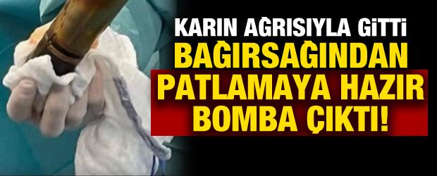Karın ağrısıyla gitti: Bağırsağından patlamaya hazır Alman mermisi &ccedil;ıktı!