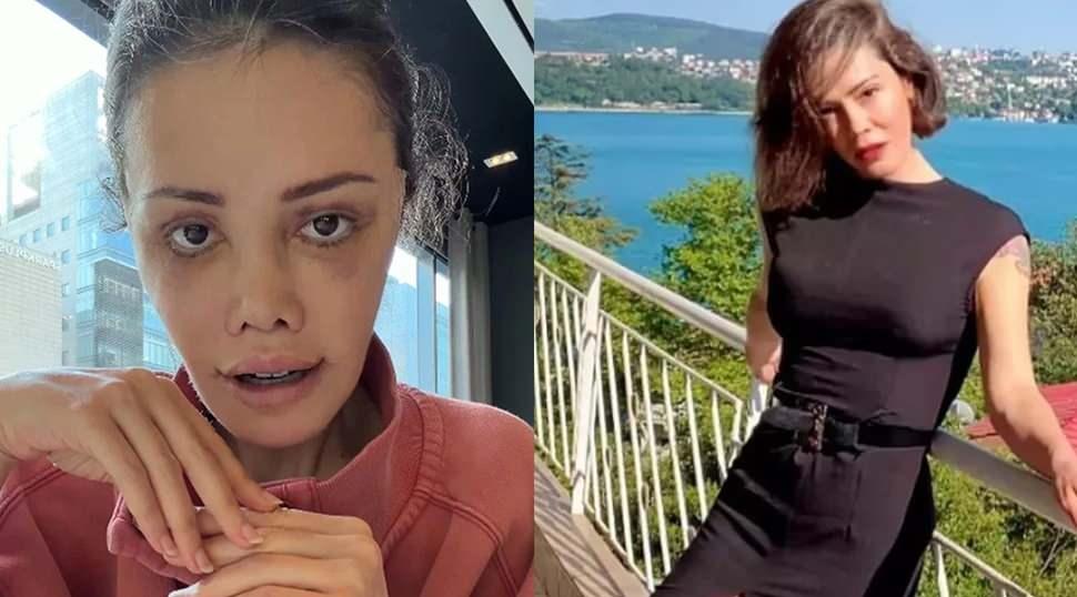 Y&uuml;z nakli sonrası kaşında sa&ccedil; &ccedil;ıktı! Didem Ceran'dan şaşırtan paylaşım