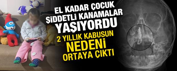 5 yaşındaki &ccedil;ocuğun burnundan &ccedil;ıkan şoke etti! 2 yıl sonra fark edildi 