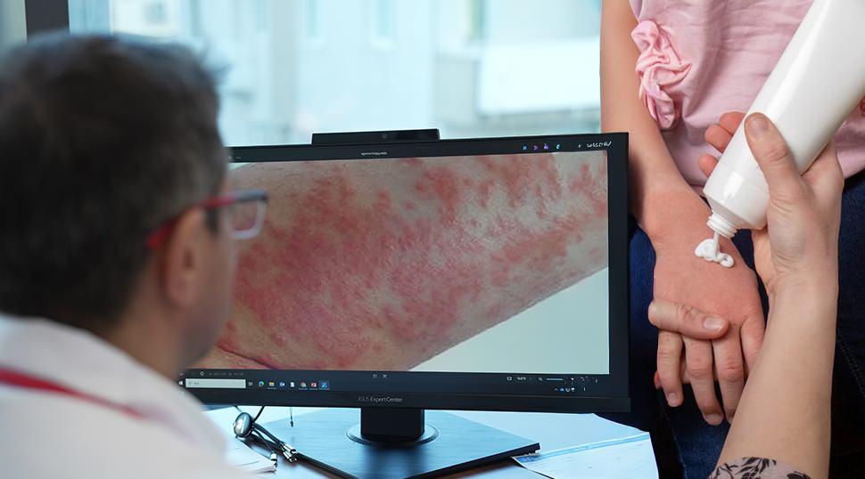 Uzman isim uyardı: Egzaması olan &ccedil;ocuklarda gereksiz diyet alerjiyi tetikleyebilir