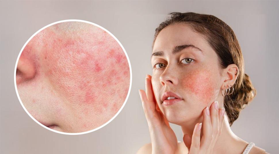 G&uuml;l hastalığı sandığınızdan daha yaygın: G&uuml;l hastalığının ilk belirtileri nelerdir?