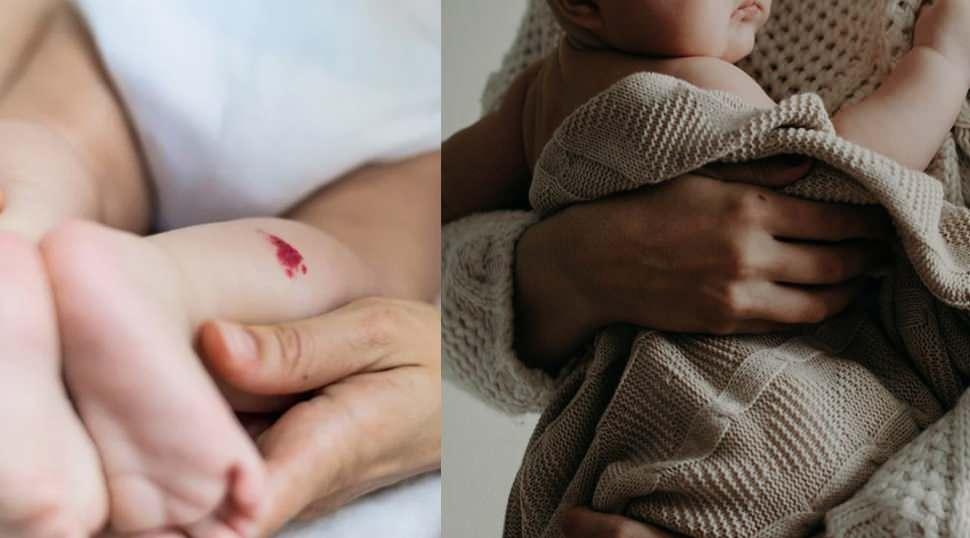 Doğum lekelerine dikkat! Ciddi n&ouml;rolojik hastalıkların ilk işareti olabilir