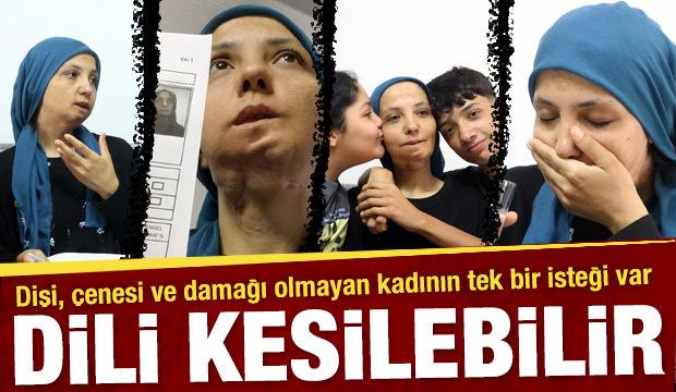 11 yılda 35 kez ameliyat oldu: 3 &ccedil;ocuk annesi kadının dili kesilebilir
