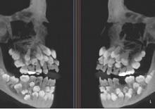 Tıp d&uuml;nyası şaşkın: 11 yaşındaki &ccedil;ocuğun 81 dişi olduğu tespit edildi!